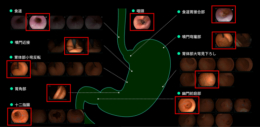 富士フイルム／AI技術を活用して上部消化管内視鏡検査レポート作成の負担を軽減 内視鏡レポート作成支援ソフトウェア新発売（24.9.27）