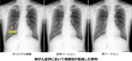 コニカミノルタ／胸部X線画像診断支援AI「CXR Finding-i」の 検出精度改良を達成（24.10.29）